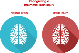 Concussion Care - Northern Virginia - Virginia Orthopedics Sports ...